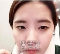 上海宏康整形医院做了双眼皮，爸妈都说很好看哦～ width=