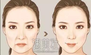 成都,鼻唇沟提升术