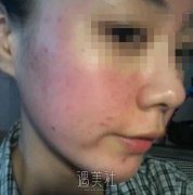 果酸换肤有果吗?刚做果酸换肤不久的我很有发言权~ width=