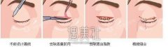 西宁做全切双眼皮可能需要多少钱?想做的盆友来收藏! width=