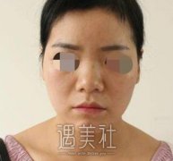 找上海九院余东给我做了隆鼻，果没有受流言蜚语的影响～ width=