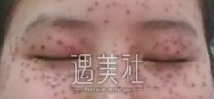 广州曙光医院做了激光祛斑，同学们不再笑我是“斑马脸”～ width=