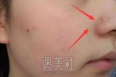 红血丝