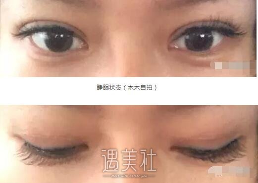 仁济医院皮庆猛双眼皮案例：看来单眼皮确实不适合我!
