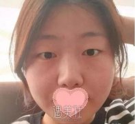 九院王丹茹双眼皮案例：我爸看了都有想做的冲动! width=