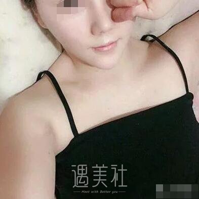 中日友好医院才杰隆胸案例：公立医院的技术就是靠谱!