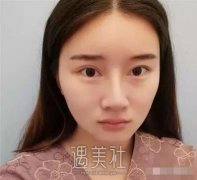 中日友好医院高占巍面部轮廓整形案例，来看看哇～ width=