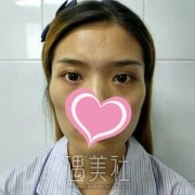 邓智仁医生之前给我做的面部填充，现在面部很饱满呢~ width=