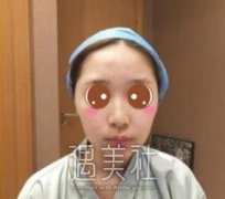整形垫下巴前后对比图：助我打败短下巴这个致命敌人~ width=