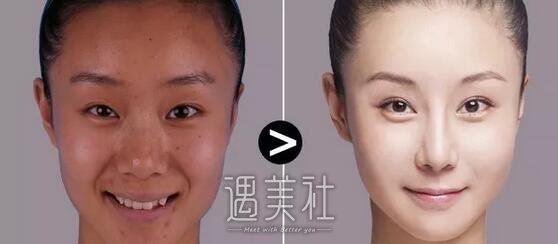 面部光子嫩肤价格