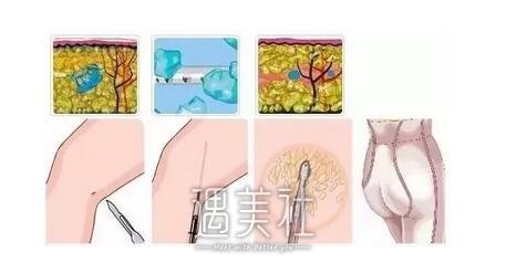 360度吸脂
