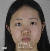 成都西区医院隆鼻案例分享，我们成都人都喜欢去~ width=