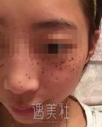 找长春中妍美容院窦颖做了祛雀斑，脸上顿时干净不少~ width=