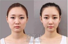 西安打注射瘦脸大概需要多少钱?注射越多收费越贵吧? width=