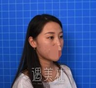 成都悦好陈国双双眼皮案例：看来口碑好是有原因的~ width=