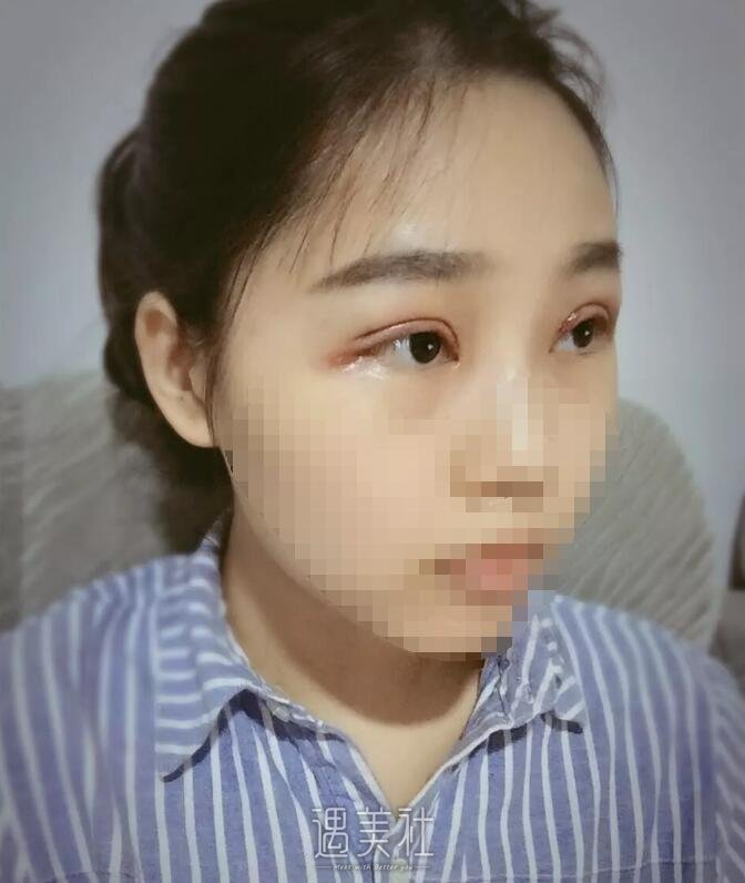 武警医院蒋亚楠给我做的双眼皮，目前恢复得灰常不错~