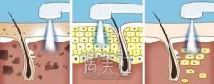 激光嫩肤的危害与果都有哪些，网路上是这样分析的~ width=