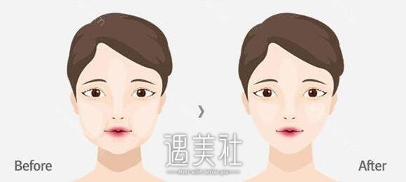 去颊脂垫有副作用吗