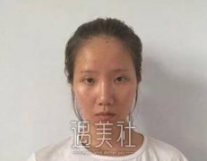 找徐永安医生做了面部填充，半年多恢复得相当不错啊！ width=
