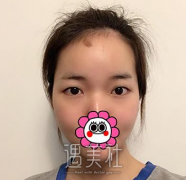 刘珍君做双眼皮怎么样|刘珍君双眼皮案例呆萌登陆~ width=