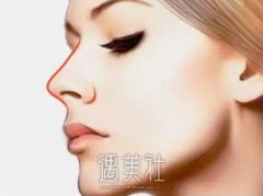 膨体隆鼻没问题吗，膨体隆鼻术后会有副作用后遗症之类的吗? width=