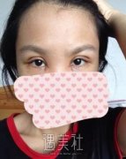 杨明勇双眼皮案例：早就有耳闻杨医生做双眼皮很牛皮~ width=