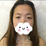 王佳琦医生双眼皮案例：硬核力证王佳琦双眼皮技术~ width=
