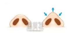 厦门鼻头缩小手术果好不好，听说隆鼻都要做这个? width=