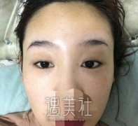 张余光双眼皮案例：早就听说张医生做双眼皮很腻害! width=