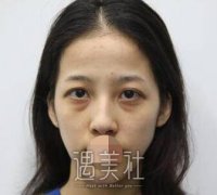 上海九院李圣利切眼袋案例：大佬做这个就是小菜一碟~ width=
