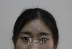 刘珍君双眼皮案例：这样的双眼皮我表妹看了都心动！ width=