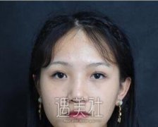 郑京湘双眼皮案例：开始后悔没有早点做双眼皮！ width=