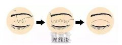 淄博做埋线双眼皮果怎么样，有没有不适的症状? width=