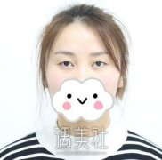 孙宝珊双眼皮案例分享，前后果看得见哦~ width=