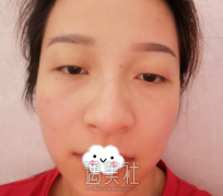 赵延勇双眼皮案例：手术过程没想象中恐怖~ width=