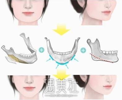 改脸型价格