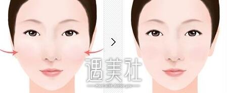 改脸型价格