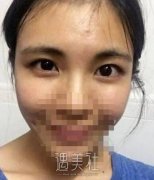 高柳进双眼皮案例曝光，前后根本不是一个人~ width=