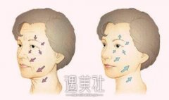 武汉拉皮祛皱价格怎么样，为什么有高有低? width=