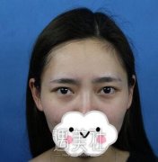 杨鹏双眼皮修复案例，手术果出乎意料~ width=