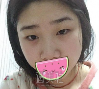 施耀明双眼皮案例~ width=