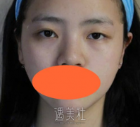 九院施耀明做双眼皮怎么样？有近期案例吗？ width=