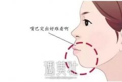 芜湖嘴唇整形大概多少钱，收费标准是什么? width=