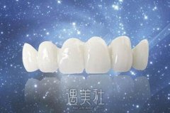 成都美容冠矫正龅牙多少钱，听说价格都很贵? width=