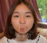 四川陈辉医生双眼皮修复案例~ width=
