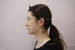 黎星下巴取出案例：术后150天恢复历程~ width=