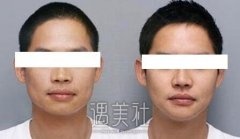 东莞脸部削骨手术多少钱，越贵果越好吗? width=