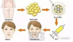 南昌自体脂肪除皱的果好吗，能维持多长时间? width=