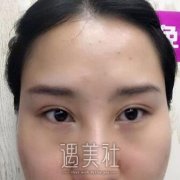 张余光修复眼案例：张医生技术很娴熟果很不错~ width=
