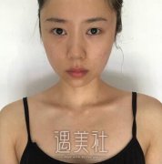 王涛隆鼻案例：目前恢复得hin不错哦~ width=